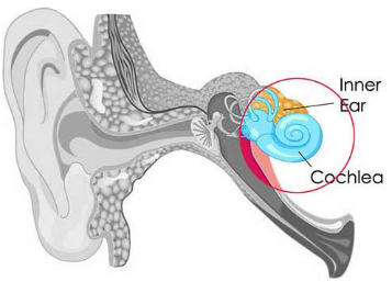 Sensorineural Hearing Loss